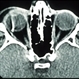 Intraocular Foreign Body, Metallic, CT Scan Orbits Intraocular Foreign Body, Metallic, CT Scan Orbits